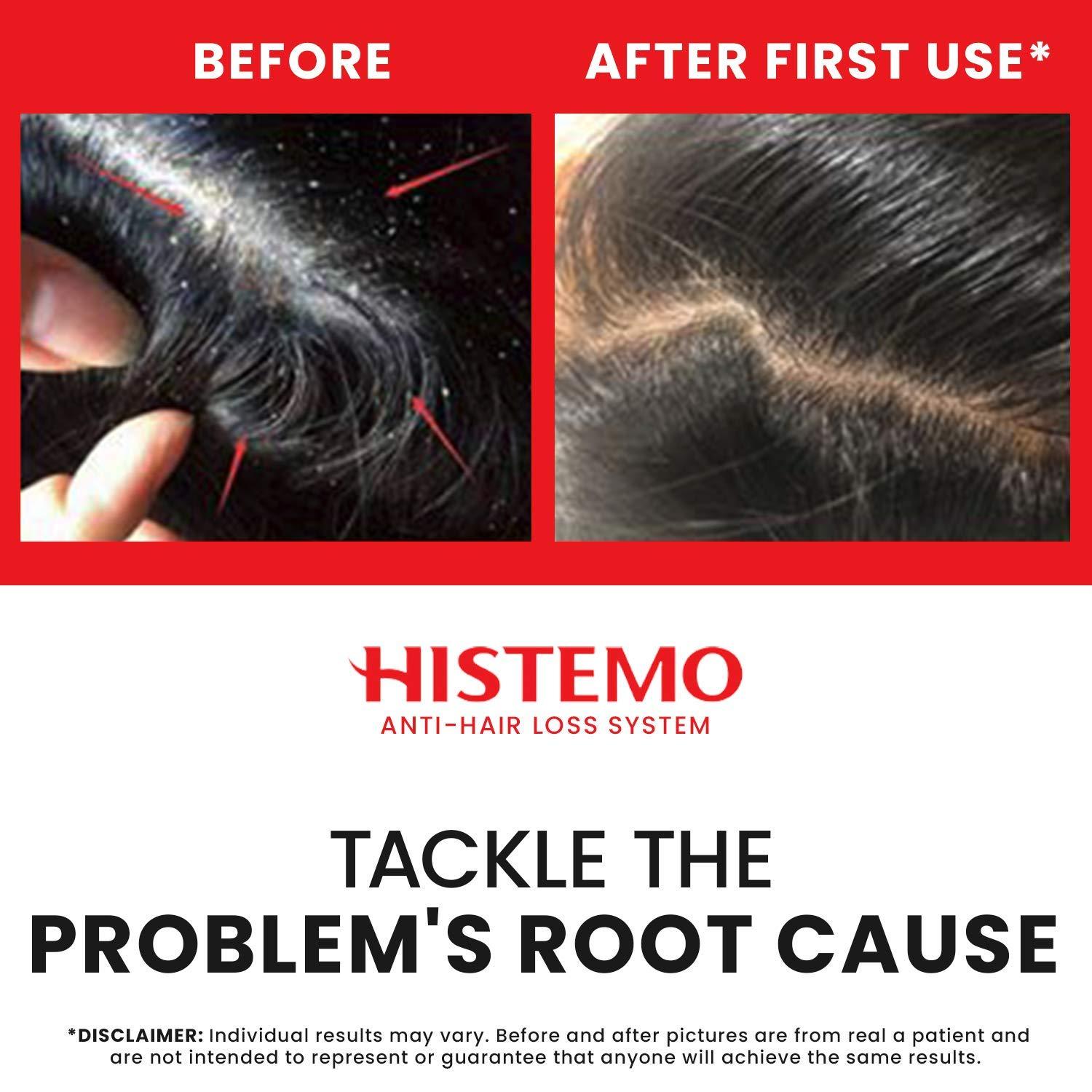 Histemo Anti-Dandruff & Oily Hair Kit, Scalp Cleanser, Shampoo, Conditioner & Hair Tonic, DHT Blocking Hair Restoration Treatment